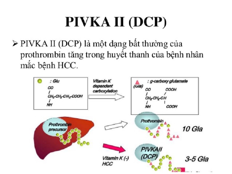 Hình 1: Xét nghiệm Pivka II trong tầm soát, theo dõi điều trị ung thư biểu mô tế bào gan