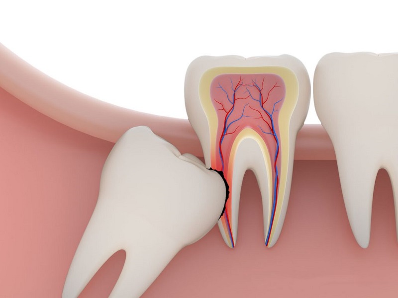 Răng khôn mọc lệch gây ra sưng đau và nhiều ảnh hưởng khó chịu tới cuộc sống