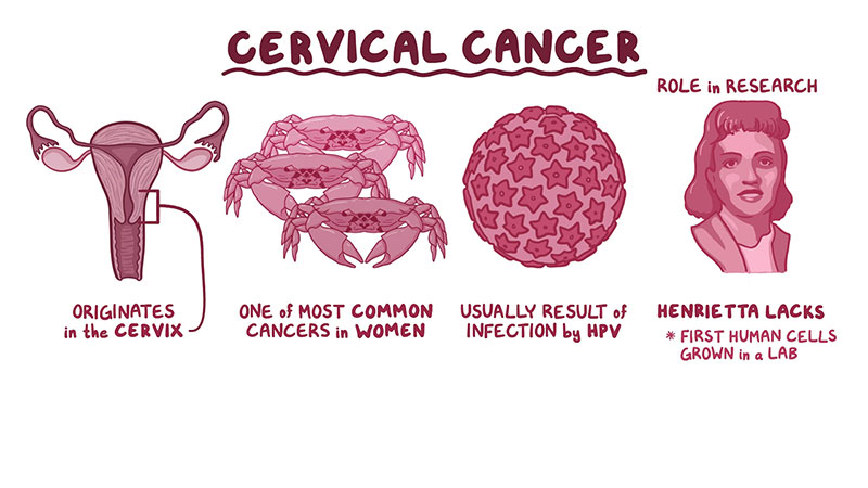 Ung thư tử cung là căn bệnh phổ biến ở nữ giới