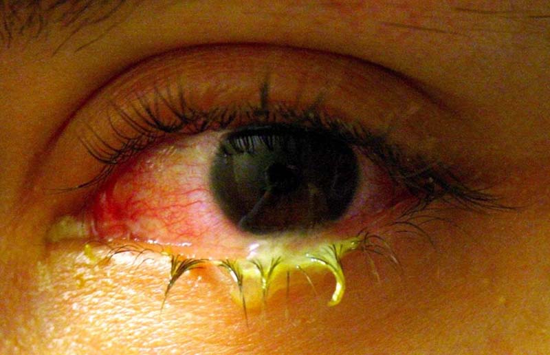 Triệu chứng thường gặp là ra gỉ mắt màu vàng hoặc xanh ở phần mí mắt
