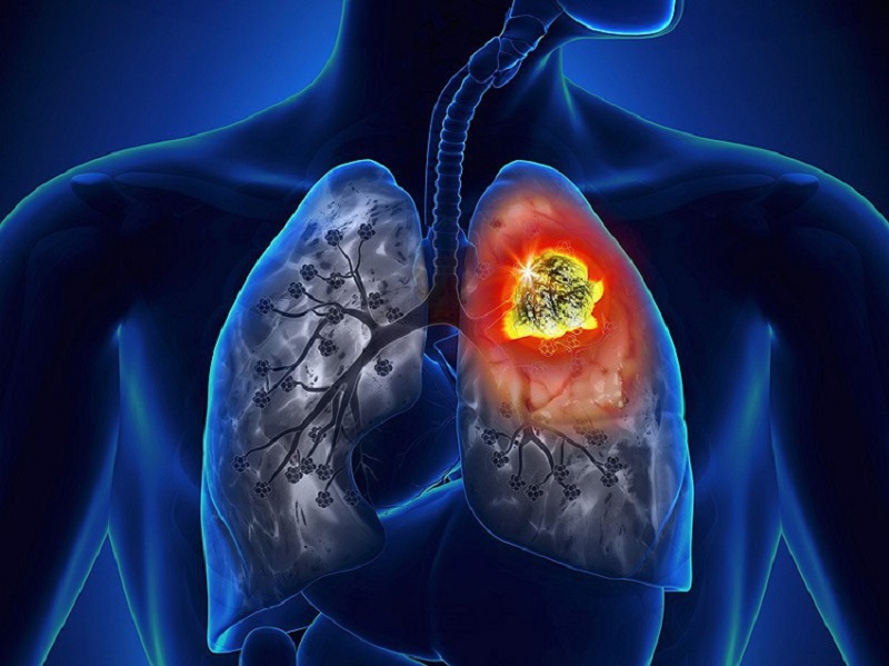 Hình ảnh ung thư phổi tế bào không nhỏ
