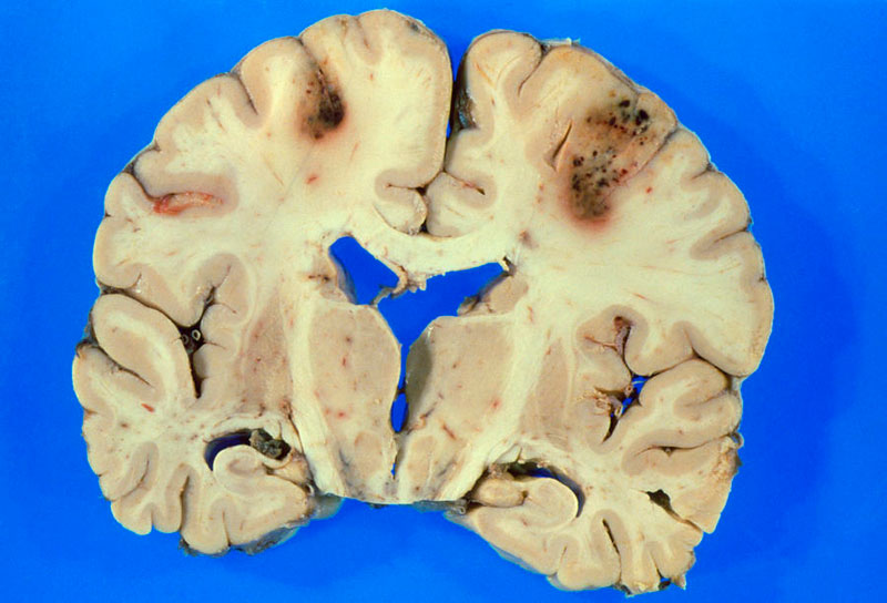 Tình trạng thiếu máu não kéo dài không được điều trị sẽ khiến vùng não đó bị hoại tử