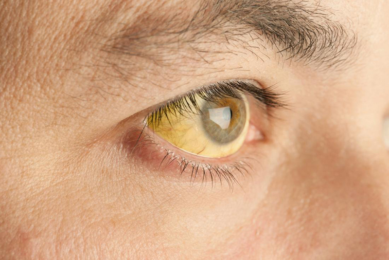 Vàng da, vàng mắt là dấu hiệu mắc các bệnh về gan