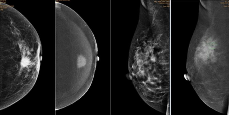 Chụp X-quang tuyến vú cho hình ảnh chi tiết nhu môi vú và khối u nếu có