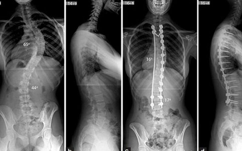 Dị dạng cột sống có thể quan sát được khi chụp X-quang lưng