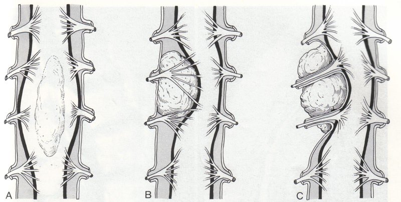 Chụp X-quang đánh giá u tủy cột sống thường cần bơm thuốc cản quang