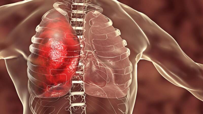  Vết mờ ở phổi khi chụp X-quang cho thấy tổn thương hoặc khối u trong phổi