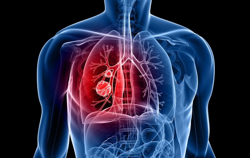  Vết mờ ác tính ở phổi có thể do ung thư