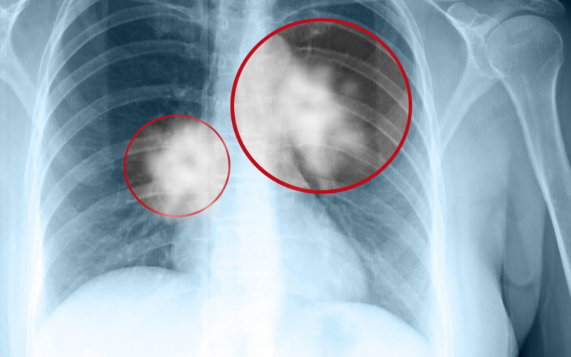 chụp X-quang phổi có vết mờ