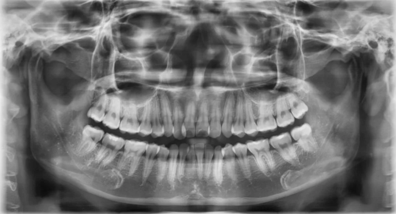 Ảnh chụp X-quang cho phép quan sát cấu trúc toàn bộ hàm răng