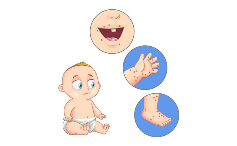 Trẻ nhỏ dưới 5 tuổi là nhóm người dễ mắc bệnh tay chân miệng nhất