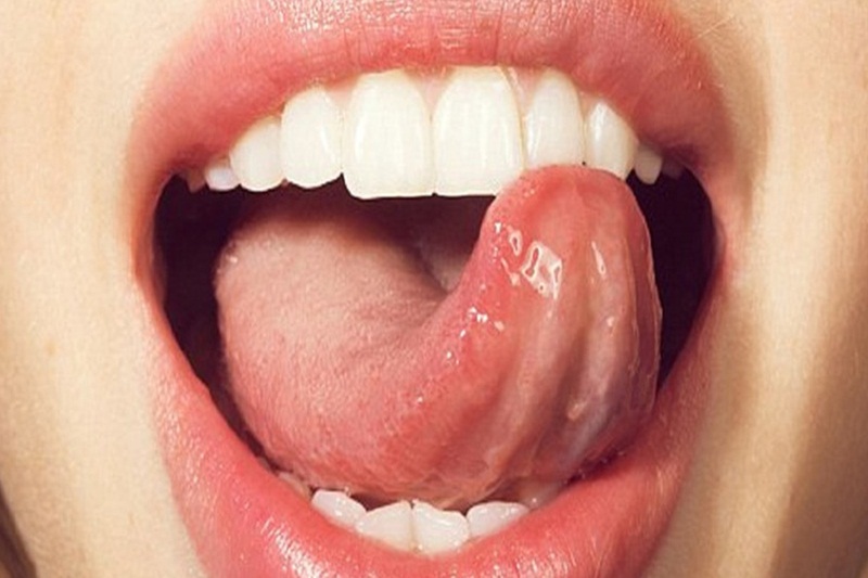 Triệu chứng ung thư lưỡi dễ nhầm với nhiều bệnh khác