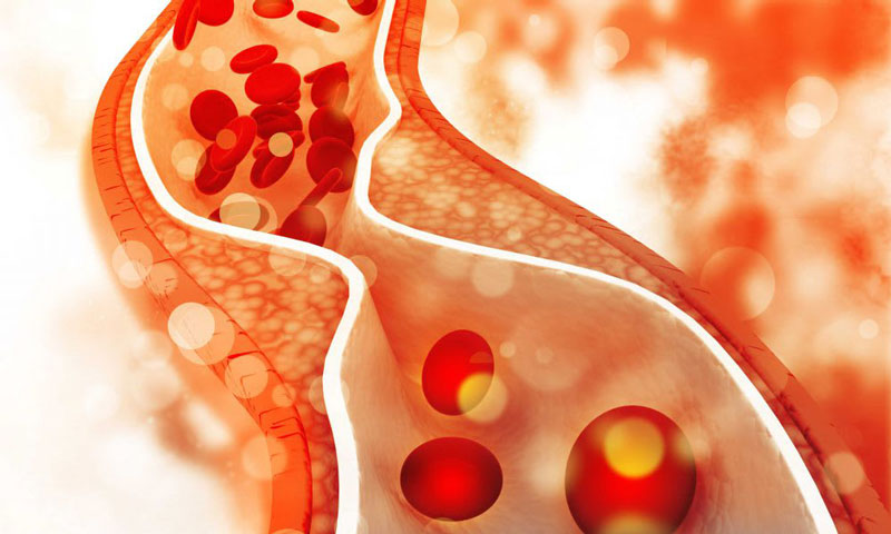 Rối loạn lipid máu là việc nồng độ Cholesterol và Triglycerid tăng cao