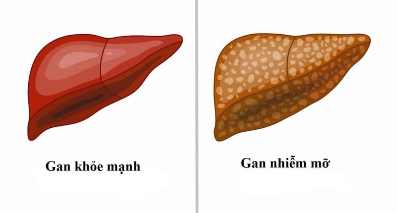Hình ảnh minh họa so sánh gan khỏe mạnh và gan nhiễm mỡ.