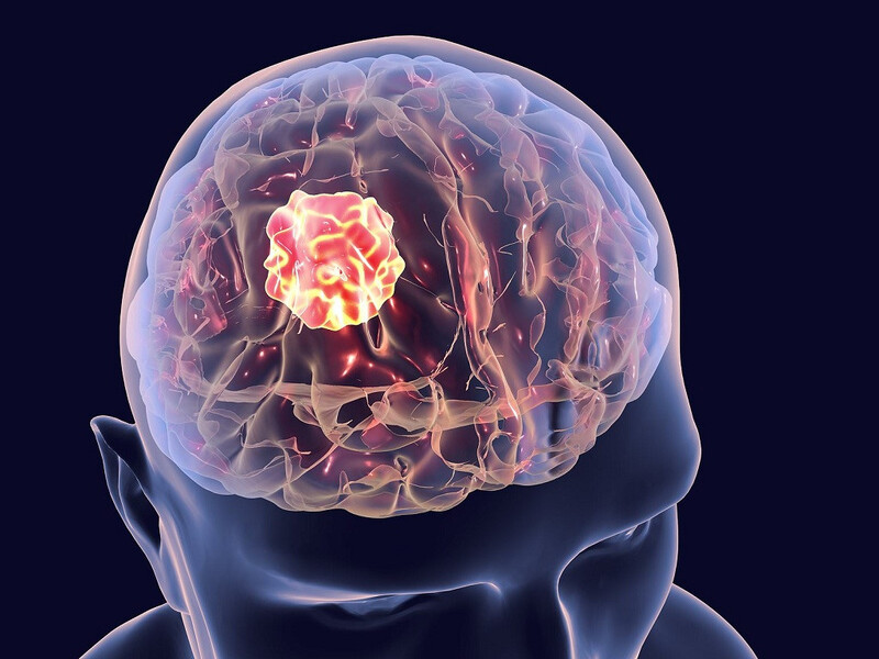  Chụp tưới máu não được chỉ định trong trường hợp u não