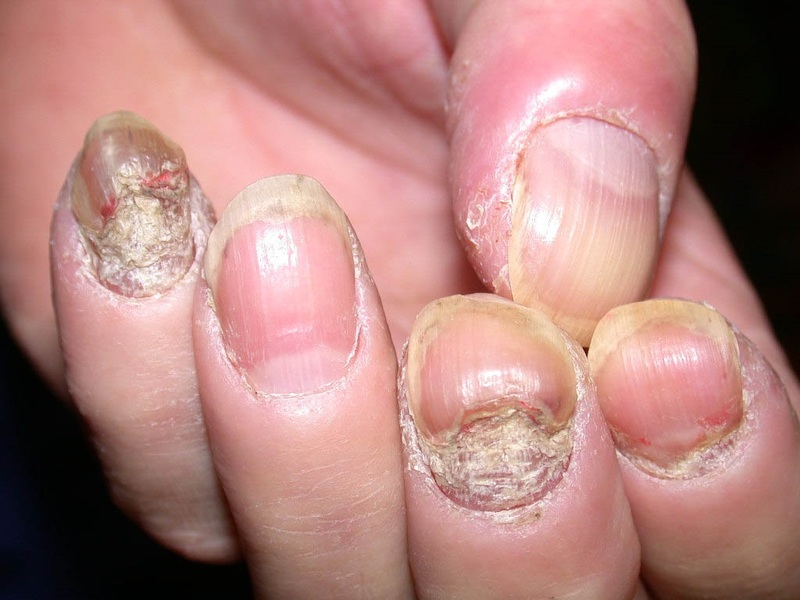 Nấm móng tay là bệnh khá thường gặp, dễ tái phát