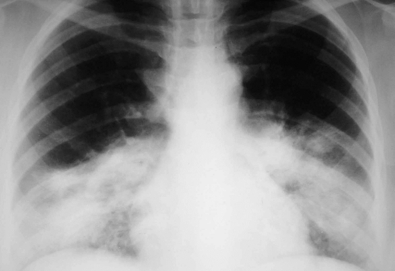 Hình chụp X-quang của người bị viêm phổi