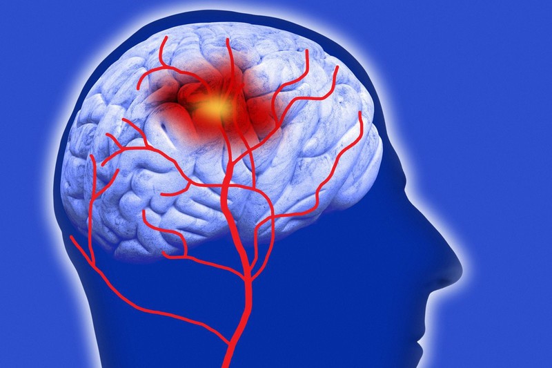 Xuất huyết não có thể chẩn đoán chính xác hơn với CT Scanner 2 mức năng lượng