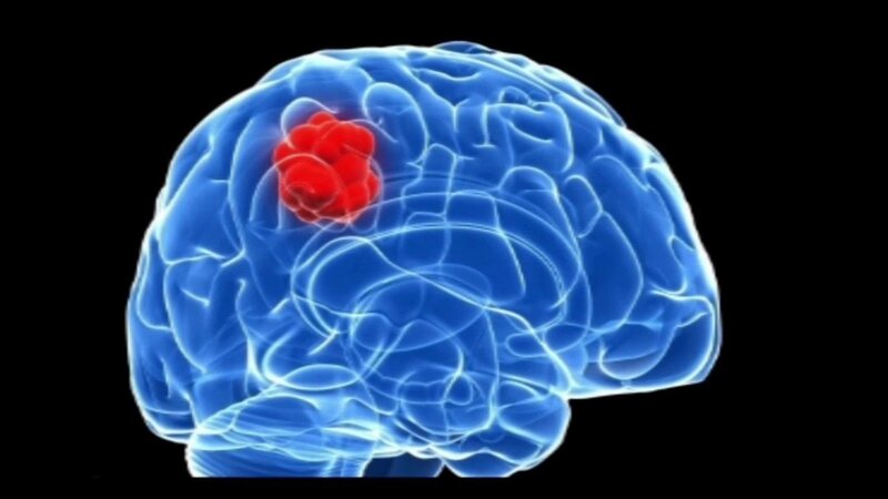  Chụp CT có khả năng phát hiện u não tới 90% kể cả các u nhỏ chưa có triệu chứng