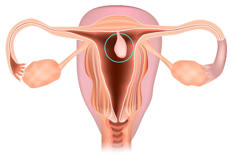 Polyp cổ tử cung không chứa tế bào ung thư nên thường được xem là lành tính