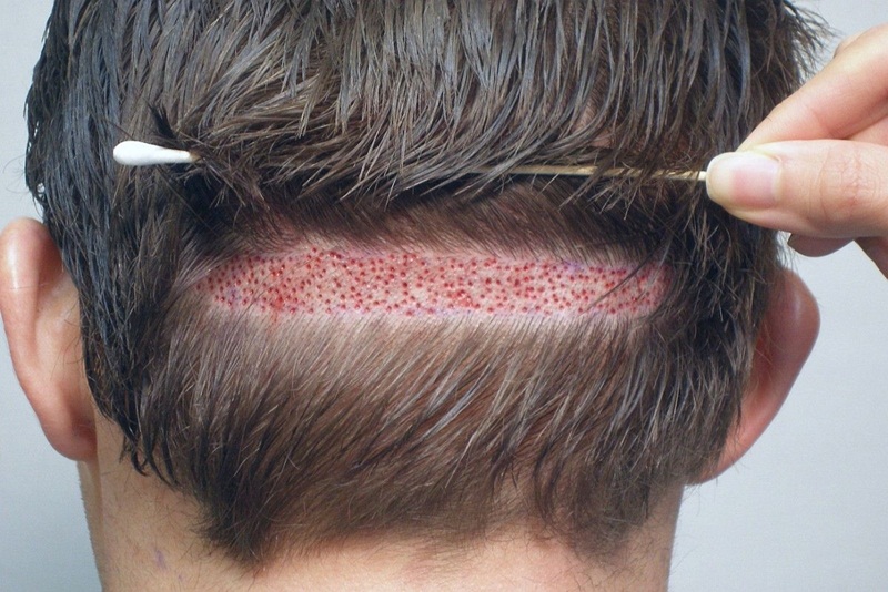 Cấy tóc là phương pháp tốn kém và đòi hỏi kỹ thuật cao nhưng cũng mang đến nhiều rủi ro