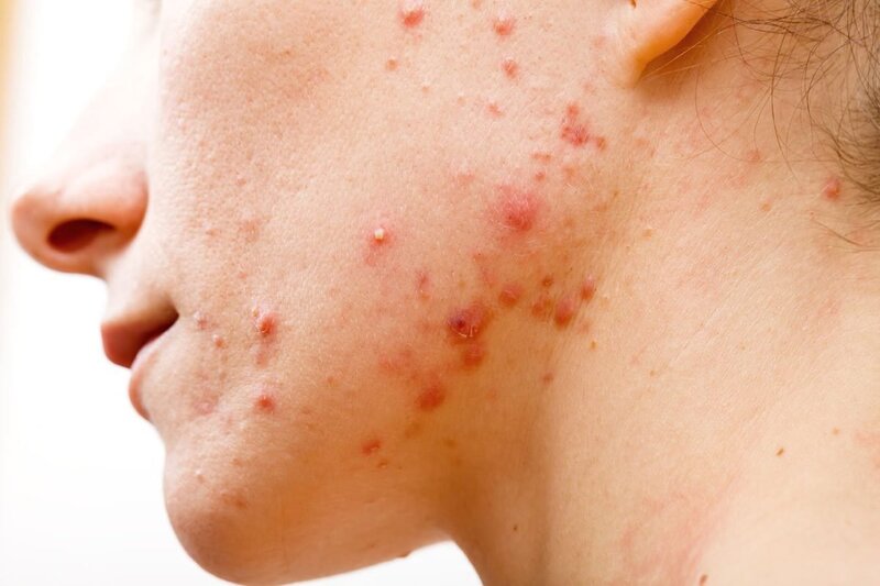 các bước chăm sóc da cần chú ý da mụn là làn da tổn thương và khó chăm sóc
