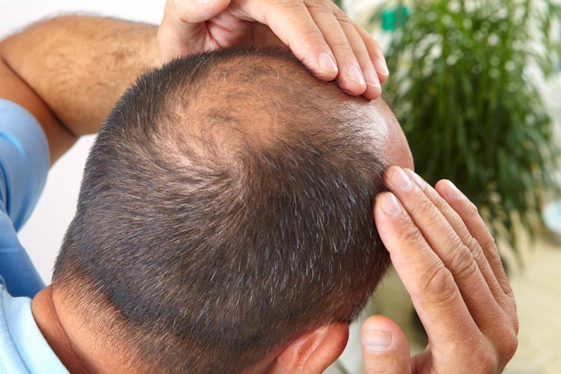 Rụng tóc quá nhiều dẫn đến hói đầu ở nam giới