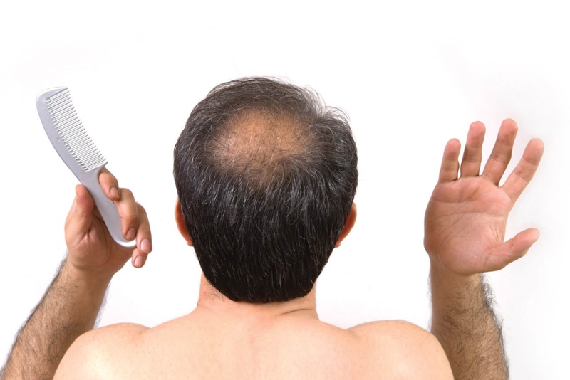 Tình trạng hói đầu ở nam giới rất dễ bị di truyền
