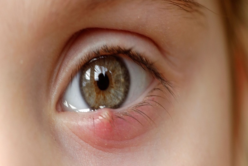 Bệnh khiến người bệnh thường xuyên khó chịu, nóng, rát mi mắt