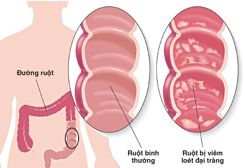 Khi bị viêm đại tràng ruột sẽ xuất hiện các vết loét khiến cho các vi khuẩn có hại tích tụ