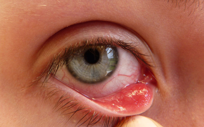 Bệnh nhân viêm kết mạc dị ứng cấp tính có biểu hiện sưng mí mắt