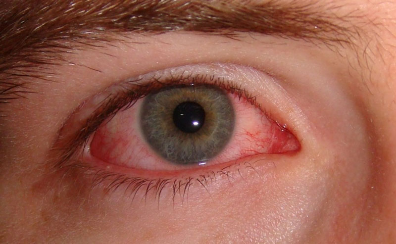 Bệnh nhân viêm kết mạc mắt có thể bị biến chứng loét giác mạc