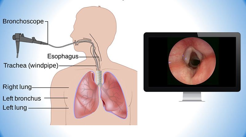 Thực hiện nội soi để kịp thời phát hiện những dấu hiệu bất thường của phổi