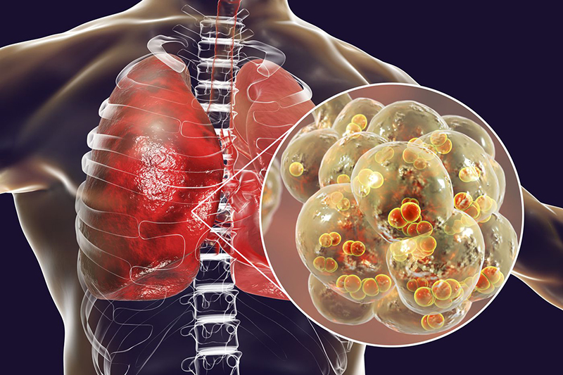Viêm nhiễm ở phổi do virus, vi khuẩn xâm nhập và phát triển ở các thùy phổi