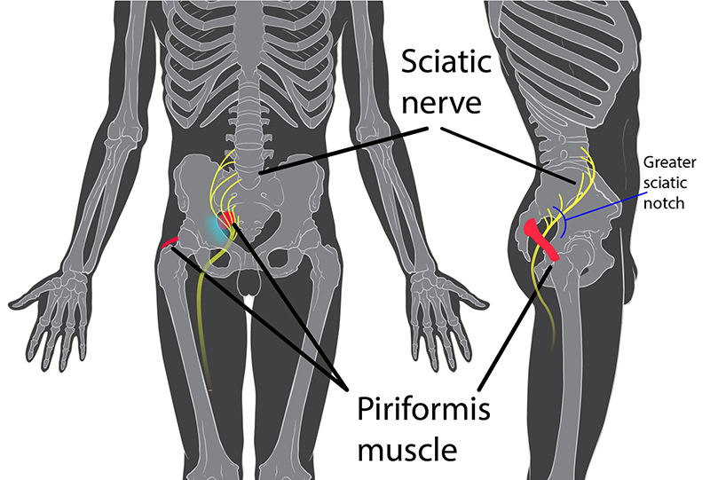 Nang ở vùng ụ ngồi nếu không được điều trị có thể gây ra nhiều ảnh hưởng đến cơ, gân, xương, khớp khu vực xung quanh