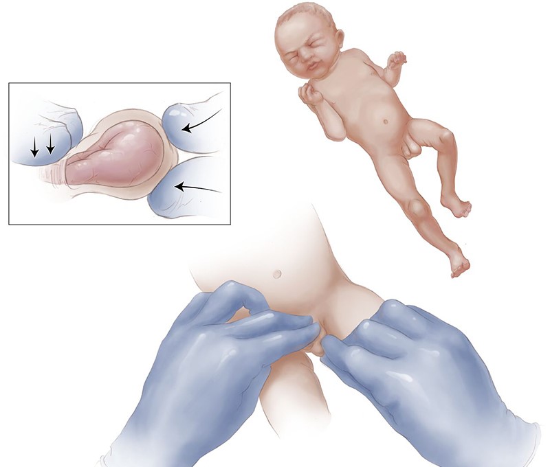 Thoát vị bẹn là bệnh lý bẩm sinh phổ biến xuất hiện nhiều ở trẻ sinh non