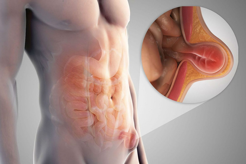 Thoát vị thành bụng xảy ra khi các tạng bên trong cơ thể thoát ra khỏi ổ bụng
