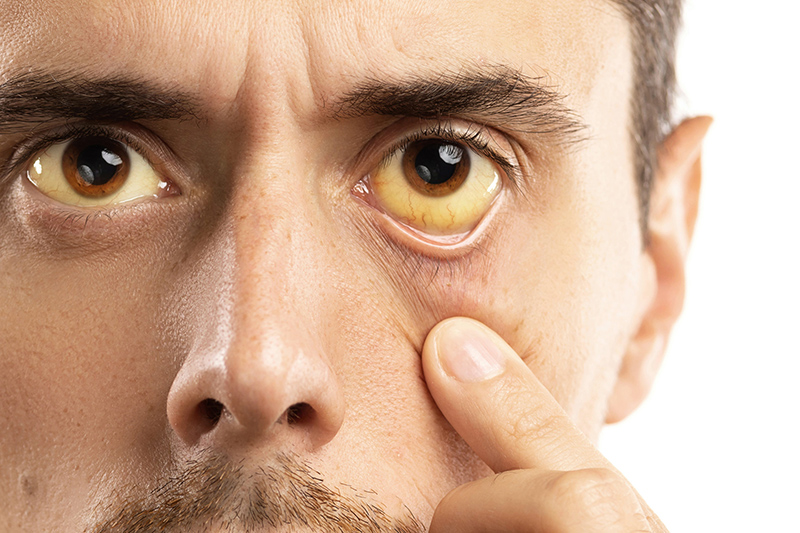 Vàng da, vàng mắt thường xuất hiện khi bệnh gan tiến triển nặng