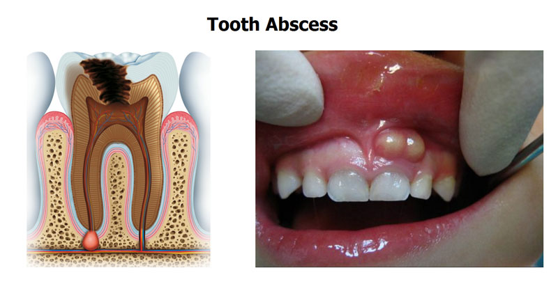 Khi thấy có ổ mủ trắng xuất hiện dưới chân răng bạn cần đến gặp nha sĩ để được tư vấn lấy tủy răng