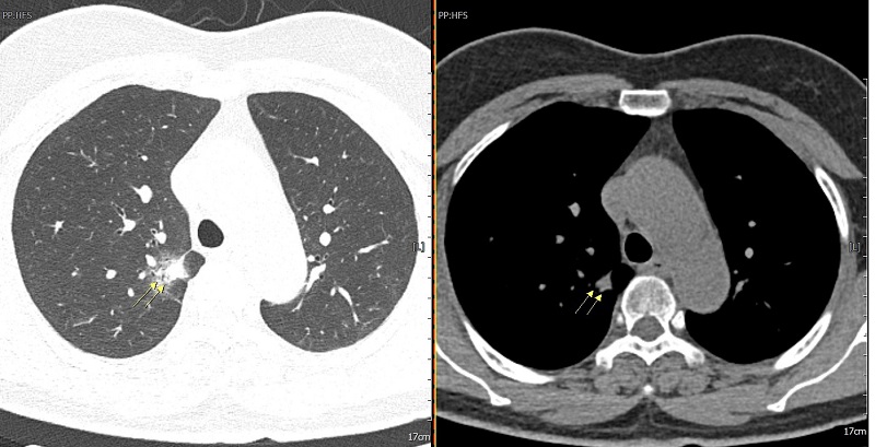 Hình ảnh khối u phổi được phát hiện bằng chụp CT 128 dãy tại MEDLATEC.