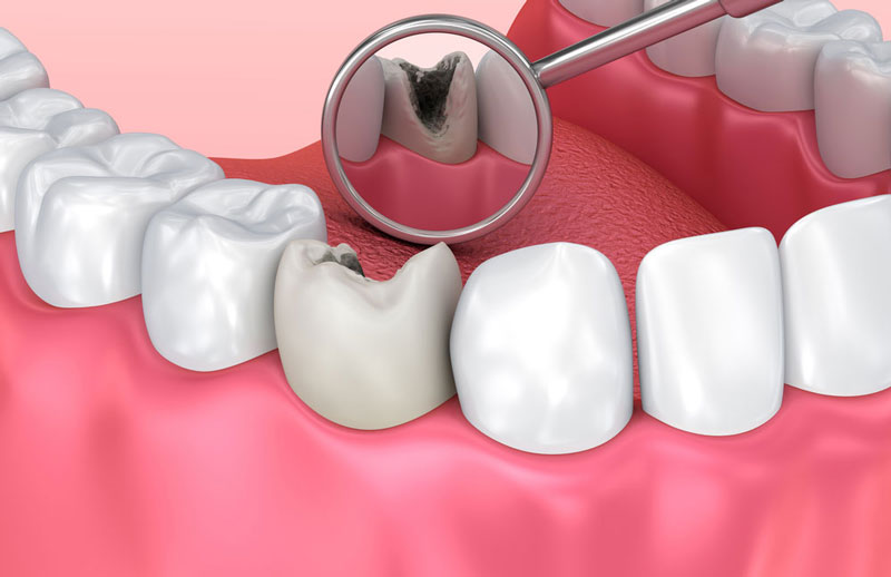 Nếu tủy răng bị viêm nhiễm nhưng không được điều trị có thể gây ra mùi hôi khó chịu và khiến răng bị rụng
