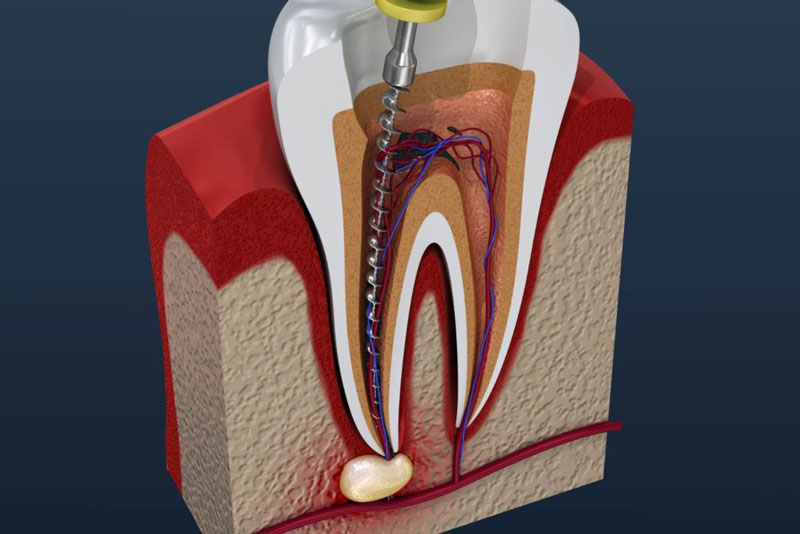 Sau khi lấy tủy bạn chỉ nên ăn thức ăn mềm, lỏng để tránh làm tổn thương lên răng vừa chữa trị