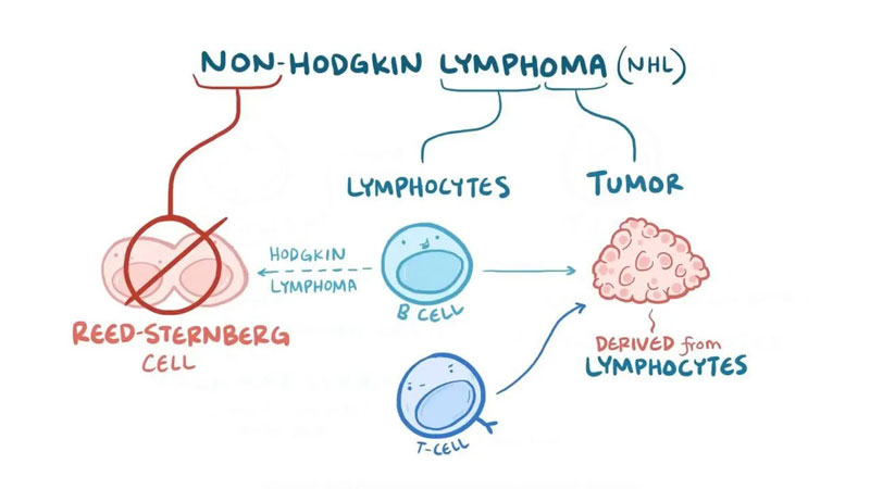 Ung thư hạch không Hodgkin là dạng bệnh gì