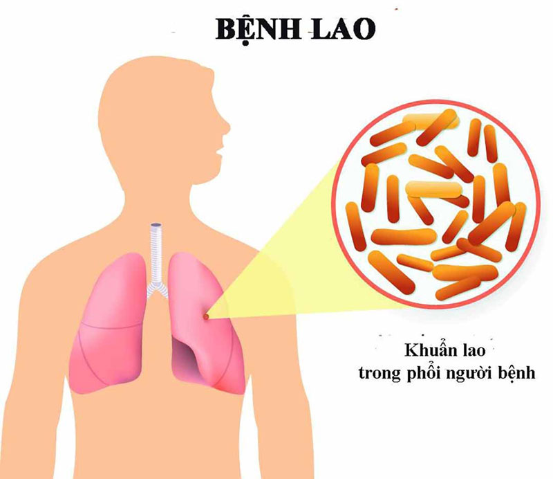 Khuẩn lao trong phổi người bệnh có thể di chuyển tới các khớp xương