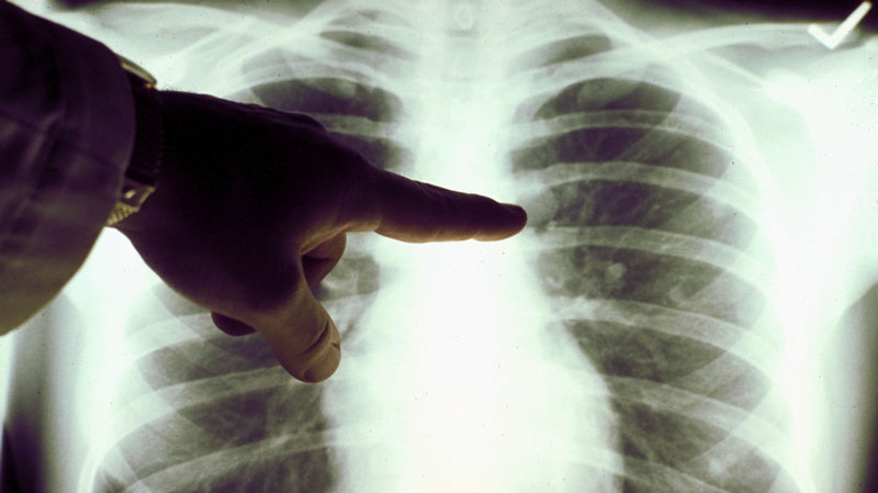 Chụp X - quang phổi để tầm soát khả năng mắc bệnh