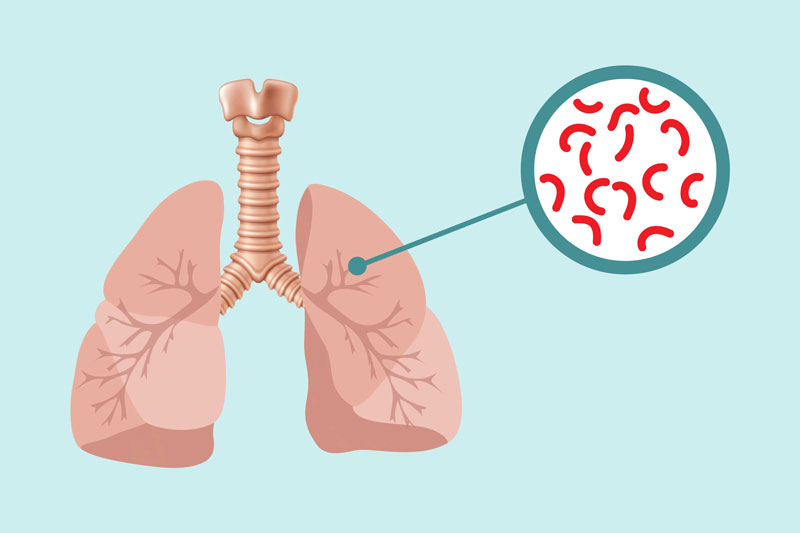 Người bị lao phổi có nguy cơ mắc bệnh rất cao