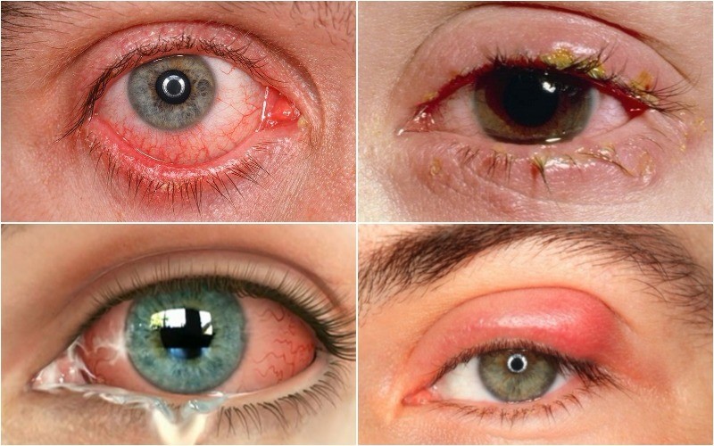 Mắt là cơ quan dễ bị tổn thường bởi nhiều tác nhân gây bệnh