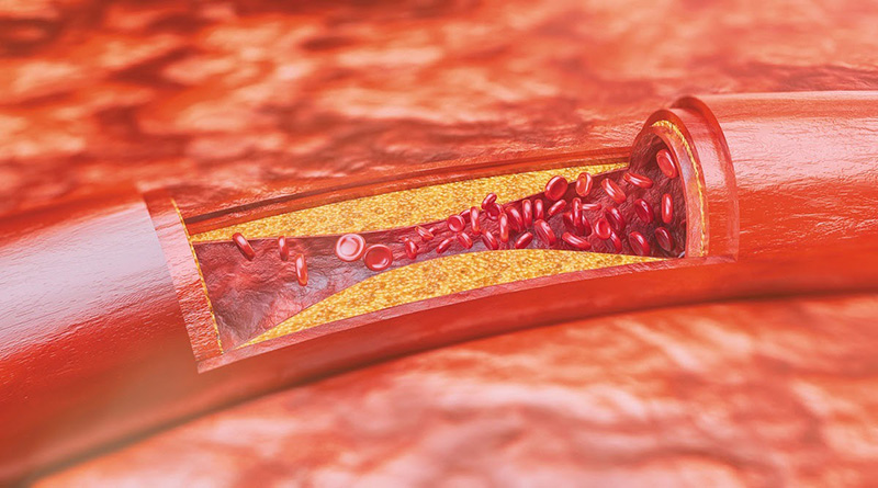 Xơ vữa động mạch gây tắc mạch máu là dấu hiệu của tai biến