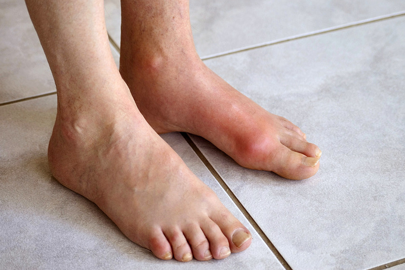Tê ngón chân cái cũng như các vấn đề xương khớp khác có thể do bệnh Gout