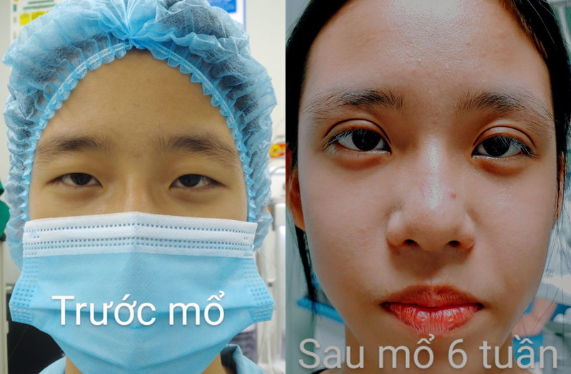 Hình ảnh bệnh nhân trước và sau khi phẫu thuật mắt tại MEDLATEC